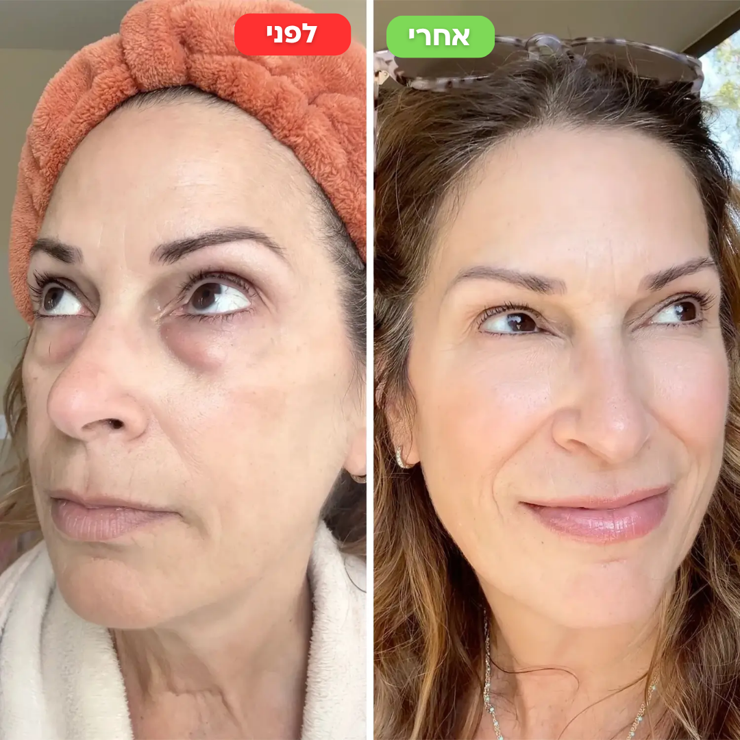 מדבקות מיקרו מחטים