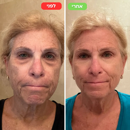 מדבקות מיקרו מחטים